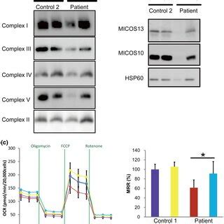 MICOS13 Mutation Reduces MICOS13 MRNA And Protein Levels And