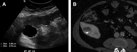 Ultrasound Of Renal Masses Radiologic Clinics