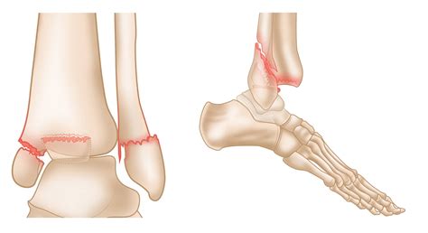 ankle fractures broken ankle orthoinfo aaos