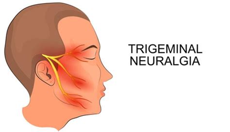 Trigeminal Neuralgia – Causes, Symptoms and Treatment – Page 2 – New ...