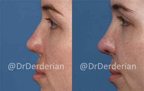 Adult Cleft Rhinoplasty And Cleft Lip Revision — Dr Derderian — Plastic And Reconstructive Surgery