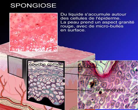 Dermato Info La Dermatite Atopique