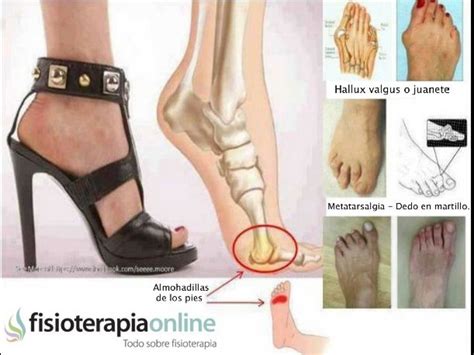 Metatarsalgias Y Juanetes Por El Uso De Tacones Fisioonline