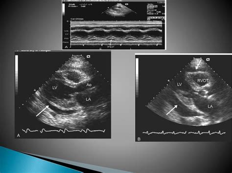 Pericardial Effusion Final Ppt