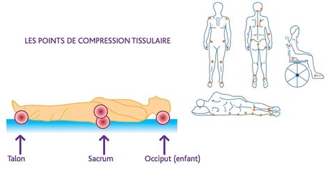 Quest Ce Quune Escarre Quelles Sont Ses Causes Et Comment La Soigner