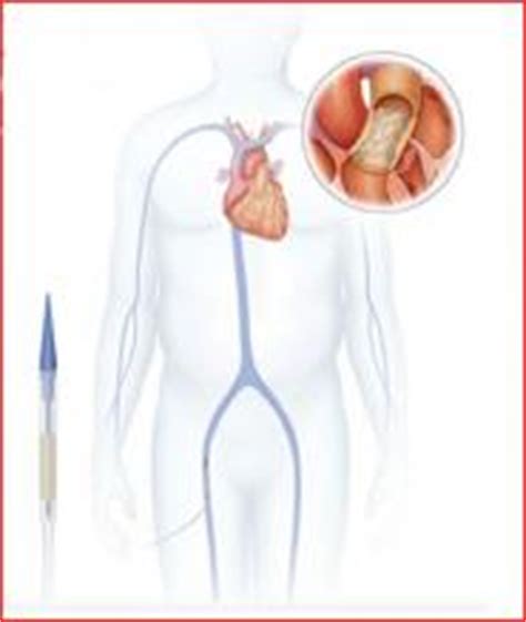 Procedure replaces heart valve, avoids open-heart surgery