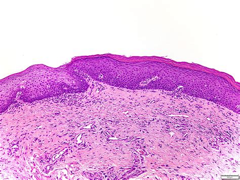 Leukoplakia Tongue Histology