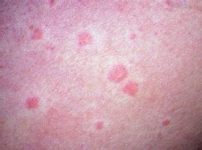 Hives Urticaria Skin Rash