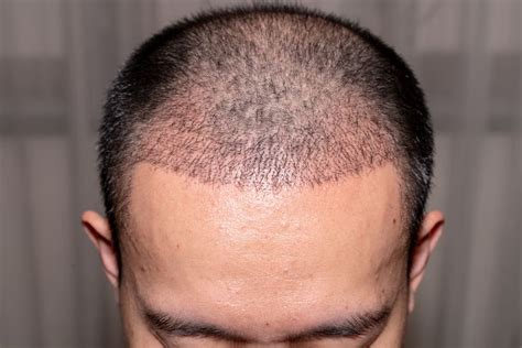 Experience A Hair Transplant Without Shaving Your Hair