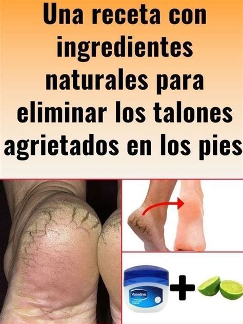 Receta Casera Para Eliminar Grietas En Los Pies Artofit