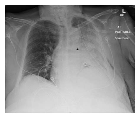 Portable Chest Radiograph Obtained On Postop Day 2 Showing Left Lung