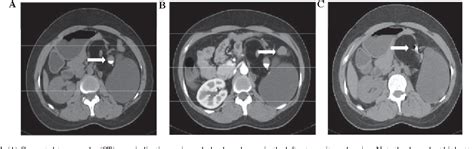 Giant Retroperitoneal Bronchogenic Cyst Mimicking A Cystic Teratoma A