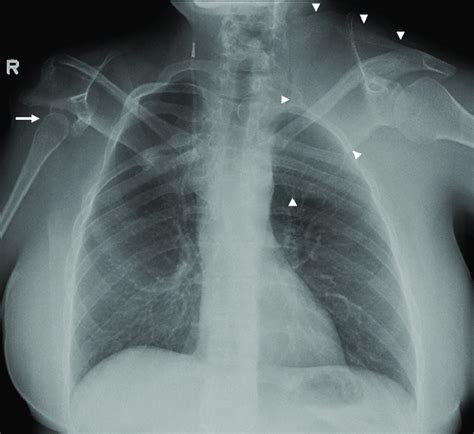 Klippel-Feil syndrome. Chest radiograph of 39-year-old female with ...