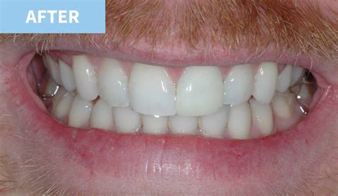 Teeth Whitening | Murray Dental Omagh