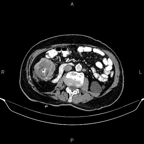 Ascending Colon Cancer Causing Intussusception Image