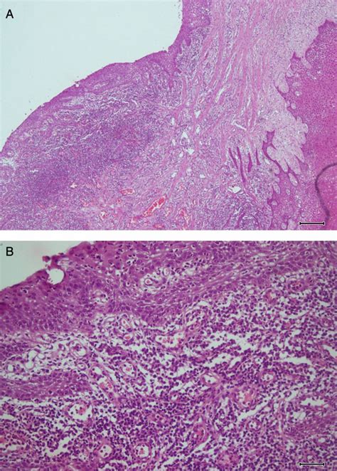 Multiple Long Standing Massive Oral Mandibular Granuloma Gravidarum