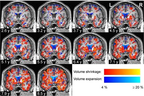 Parkinson S Disease News Research Tags Articles Neuroscience News