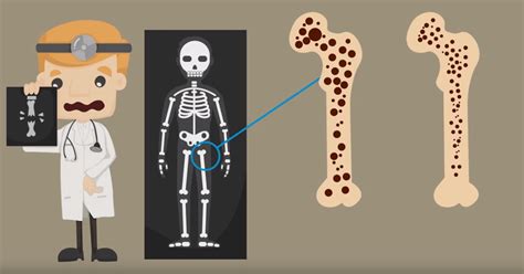 Osteoporosis Qué Es Síntomas Diagnóstico Y Tratamiento