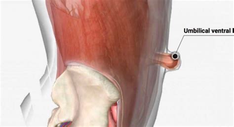 HIATAL HERNIA CSF Surgery