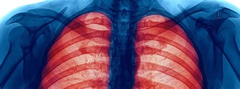 What Does A Collapsed Lung Feel Like Symptoms Causes And Recovery