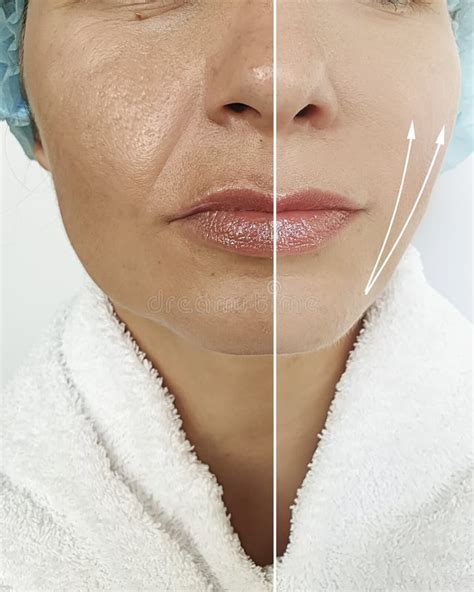 Woman Face before and after Tightening,result Collage Correction Wrinkles Stock Photo - Image of ...