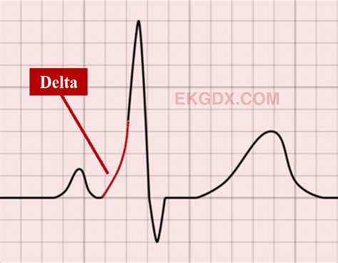 EKGDX - The new era of EKG learning