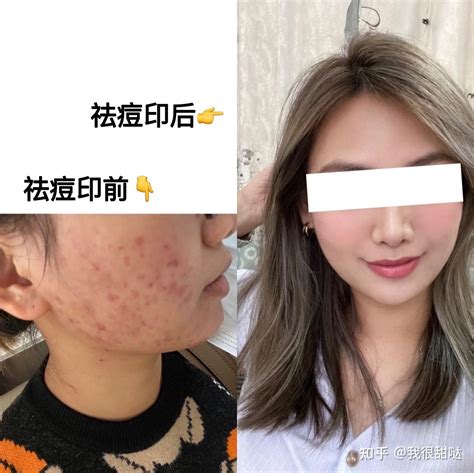 纯干货教你如何消除红色痘印、黑褐色痘印，都给我看！！ 知乎