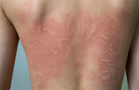 Understanding Cholinergic Urticaria Symptoms And Treatment