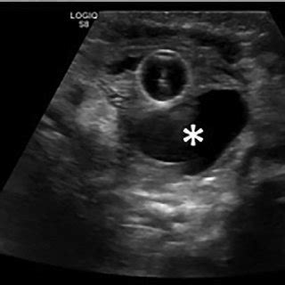 -(a) Longitudinal ultrasound image showing the duplex right kidney, and ...