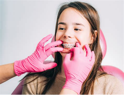 Qu Hacer Si Se Te Despega Un Bracket Gu A Completa Para Pacientes