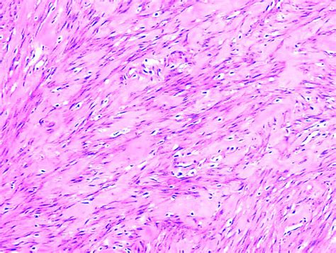 Pathology Outlines Low Grade Myofibroblastic Sarcoma