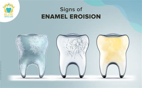 Signs Of Enamel Erosion Elite Dental Care