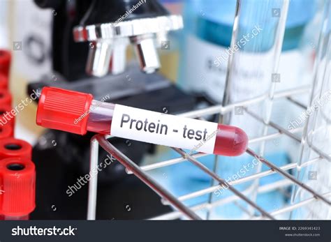 Protein Test Look Abnormalities Blood Blood Stock Photo 2269341423 ...