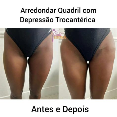 Arredondar Quadril Depressão Trocantérica Fit Body Estética