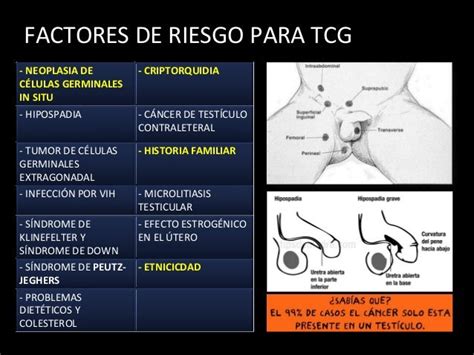 Cáncer De Testículo