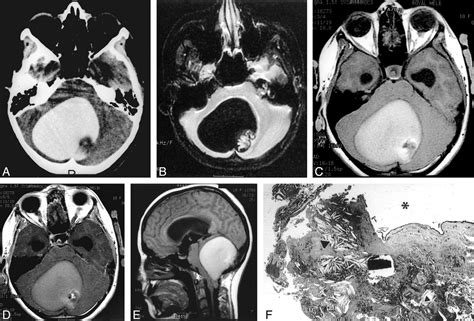 Dermoid Tumor Brain Mri