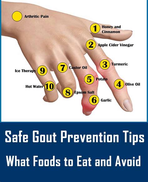 Easy Gout Treatment and Prevention Tips: Safe Gout Prevention Tips - Don't Delay Gout Treatment