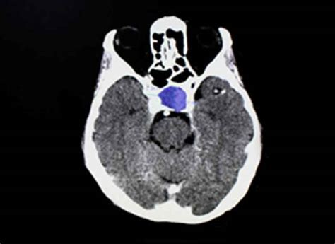 Pituitary Tumor Program Sets the Standard