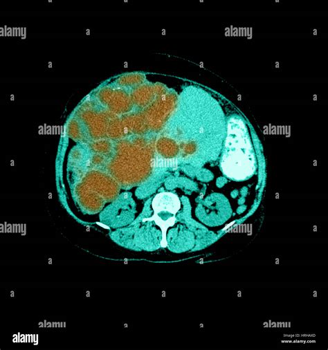 Ct of polycystic liver disease hi-res stock photography and images - Alamy