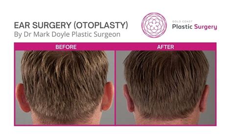 Otoplasty Before And After Photos Gold Coast Gold Coast Plastic Surgery