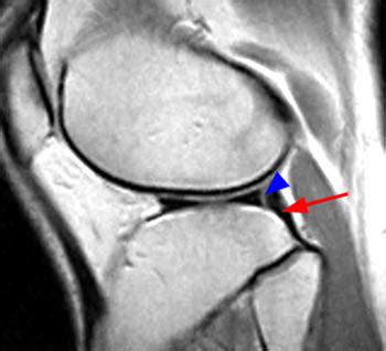 Oblique Popliteal Ligament Mri