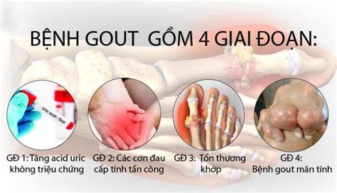 Bệnh Gout là gì Nguyên nhân triệu chứng và cách điều trị