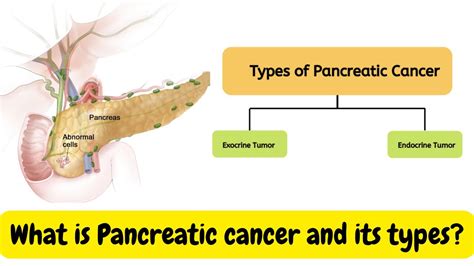 What Are The Types Of Pancreatic Cancer Youtube