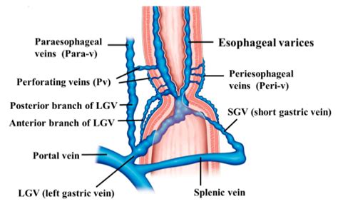 esophageal varices anatomy