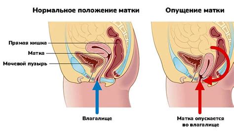 Опущение матки: причины, стадии, симптомы, диагностика, лечение и ...