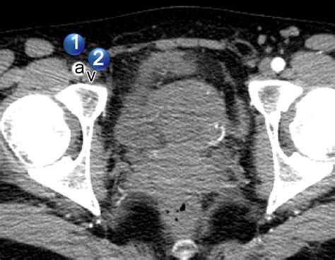 Lymphatic Metastases From Pelvic Tumors Anatomic Classification Characterization And Staging