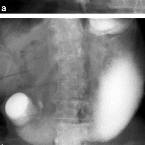 Case 1 A Stricture Of The Common Bile Duct B Stricture Of The