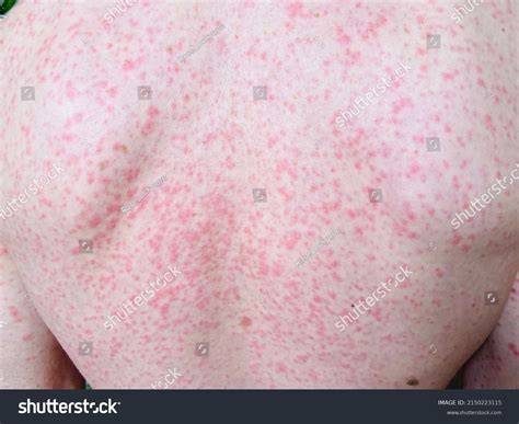 Red Spots Rash On Skin All Stock Photo 2150223115 | Shutterstock