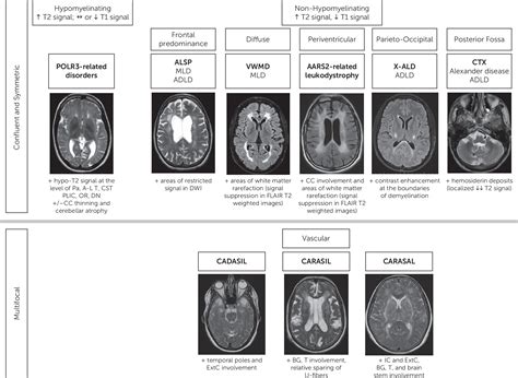 Adult Hereditary White Matter Diseases With Psychiatric Presentation