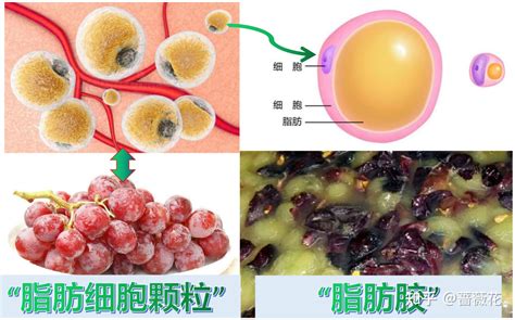 谭宏涛®浅析脂肪那些事儿？ 知乎